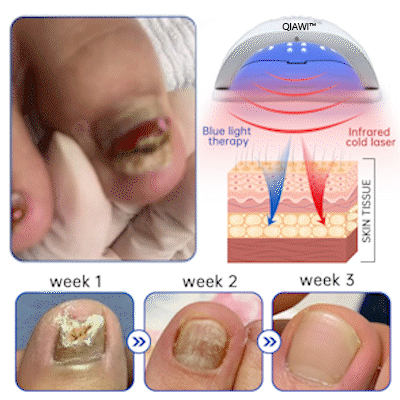 QIAWI™ PureNail Schimmel Laserapparaat